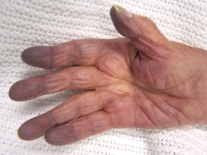Exemple d'une cyanose des doigts