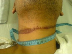Exemple d'un sillon au niveau du cou d'une victime suite à une strangulation au lien 