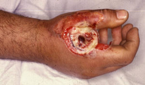 Exemple d'une blessure liée au passage d'un courant de forte intensité à travers le corps