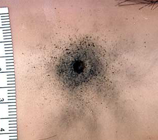 Exemple de traces de brûlures (dues aux résidus de tir) autour de l'orifice d'entrée du projectile, signe d'un tir à bout portant