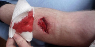 Médecine Légale – Les types de blessures