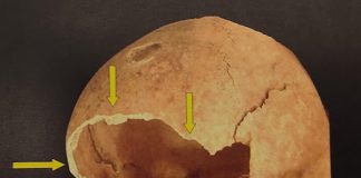 L’anthropologie médico-légale